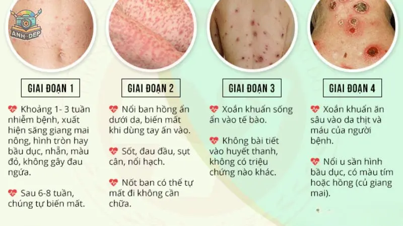 79+ Ảnh bệnh giang mai, nhận biết sớm, điều trị hiệu quả