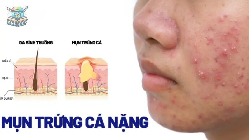 Top 89+ ảnh mụn trứng cá và nguyên nhân gây ra mụn trứng cá 