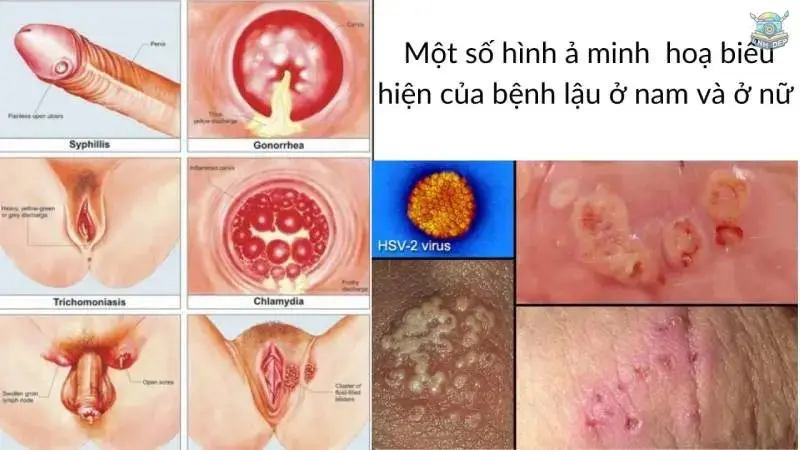 Tuyển tập hình ảnh bệnh lậu ở nam và nữ chi tiết nhất