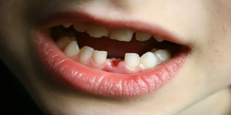 Ngủ mơ gãy răng đánh con gì? Ngủ mơ gãy răng đánh con gì?