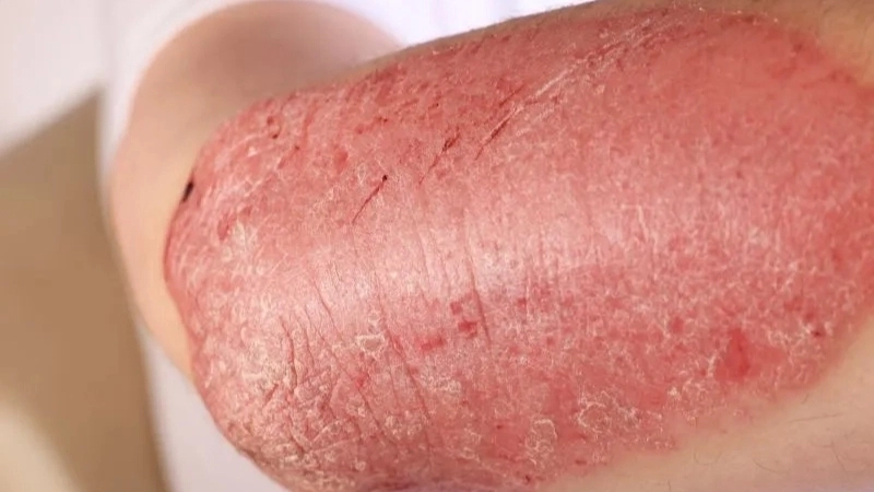 Các loại tổn thương da thường gặp ở bệnh nhân AIDS