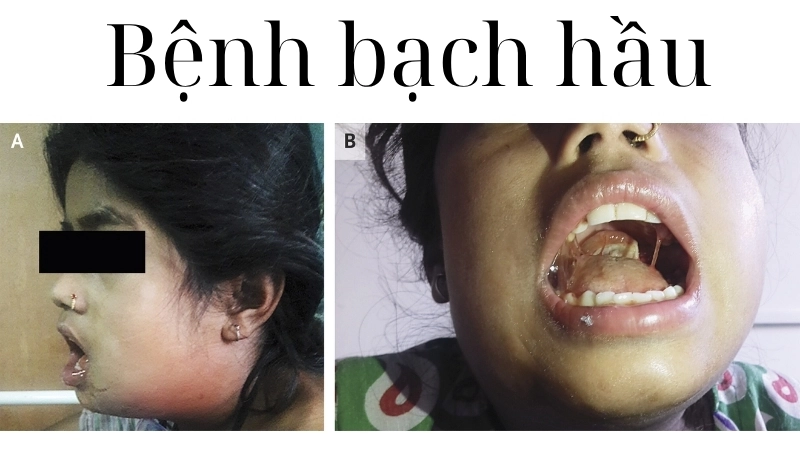 Hình ảnh bệnh bạch hầu và cách phân biệt với viêm amidan