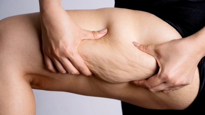 Đặc điểm của bệnh béo phì độ 1