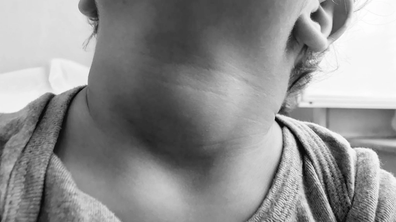 Phân biệt các loại bướu cổ qua cấu trúc và kích thước