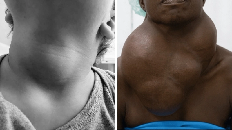 Đánh giá bướu cổ có nguy hiểm không dựa trên kết quả sinh thiết