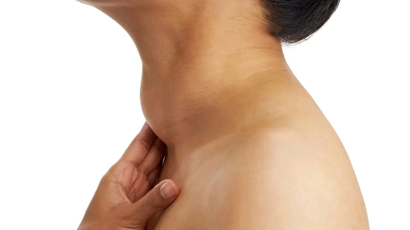 Minh họa thực phẩm bệnh bướu cổ kiêng ăn gì