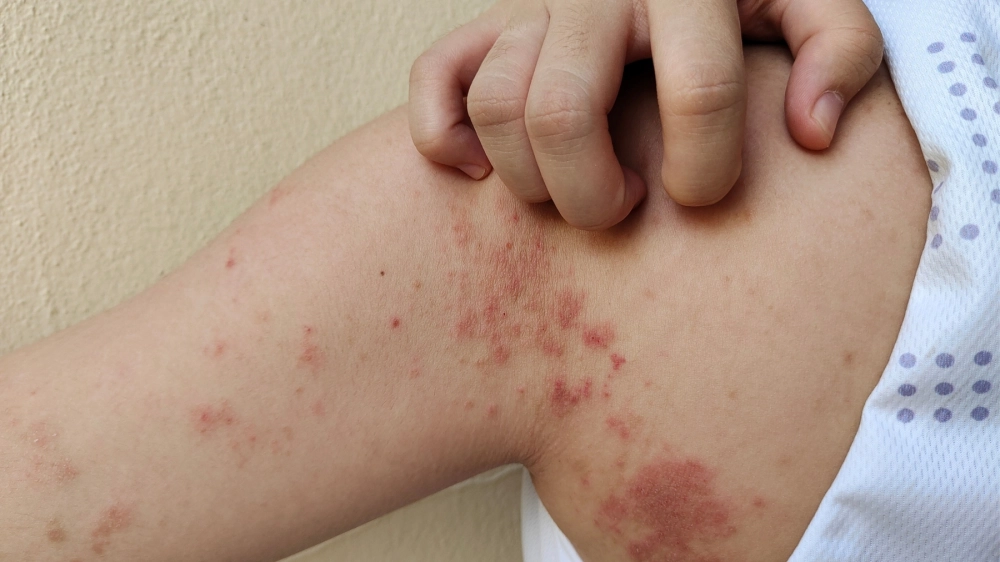 Hình ảnh vi khuẩn Fusobacterium necrophorum là một trong những tác nhân chính gây bệnh