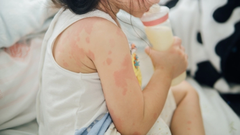 Hình ảnh bệnh chàm đỉa - Các giai đoạn nguy hiểm nhất