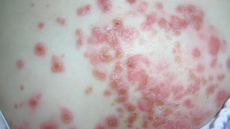 Các loại thuốc bôi chốc lở chứa kháng sinh phổ biến