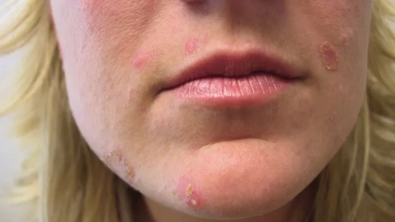 Dấu hiệu phân biệt chốc và thủy đậu qua hình thái tổn thương