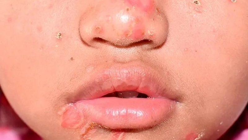 Hình ảnh bệnh chốc ở người lớn thường xuất hiện ở vùng có râu