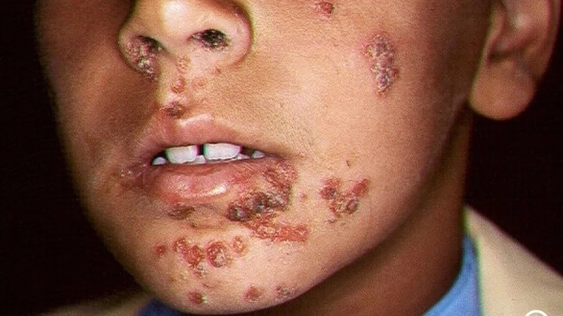 Hình ảnh bệnh chốc lở ở trẻ em và dấu hiệu nhận biết sớm