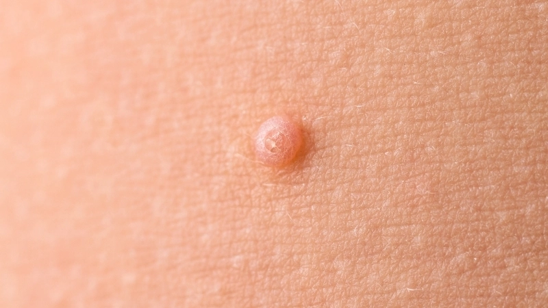 Vết thâm và sẹo sau khi điều trị bệnh đậu lào