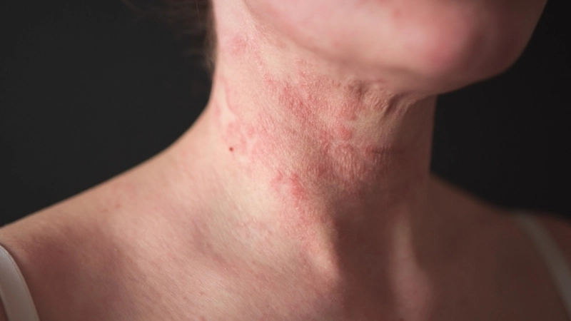 Bệnh chàm eczema là một bệnh viêm da mạn tính không lây nhiễm.