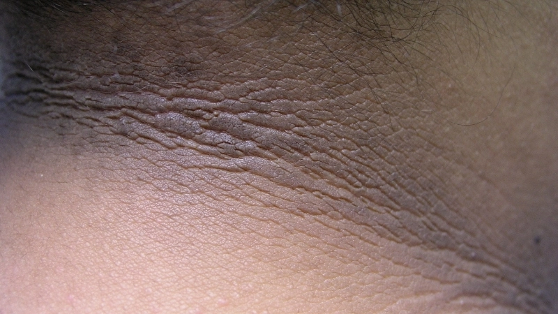 Minh họa cách chữa bệnh gai đen bằng việc điều trị nguyên nhân gốc