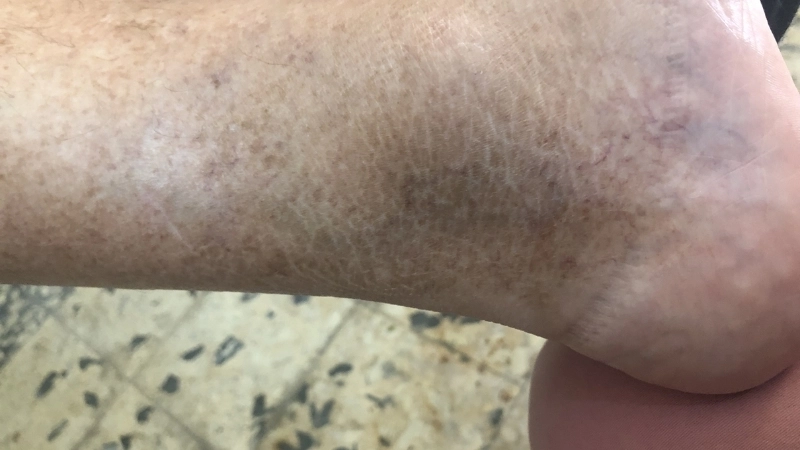 Cận cảnh các nếp da sẫm màu của bệnh gai đen ở cổ