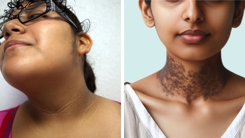 Các u mềm đi kèm triệu chứng bệnh gai đen