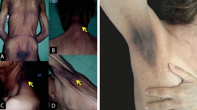 Tìm hiểu bệnh gai đen là gì qua hình ảnh lâm sàng đặc trưng.