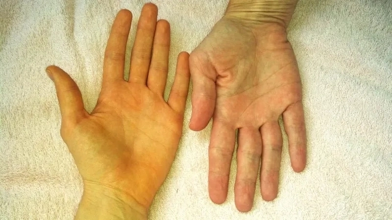 Hình ảnh bề mặt lá gan bị xơ gan hóa