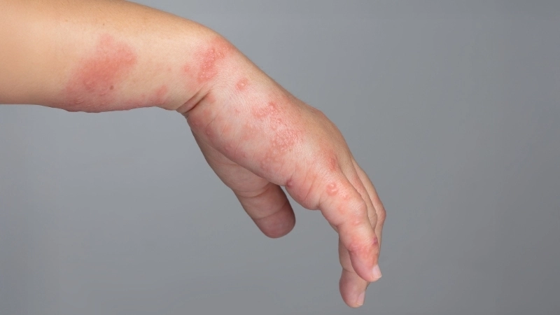 Các cách trị ghẻ ngứa tại nhà và bằng thuốc