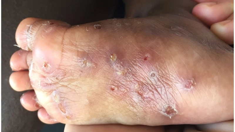 Con đường ghẻ ngứa lây qua đường nào trong cộng đồng