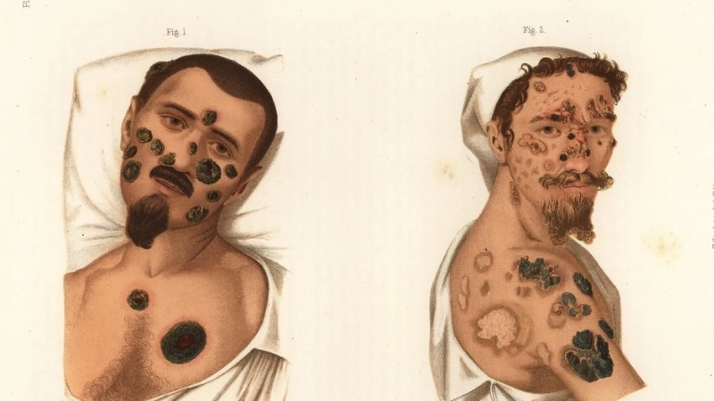 Hình ảnh bệnh giang mai - Dấu hiệu nhận biết sớm