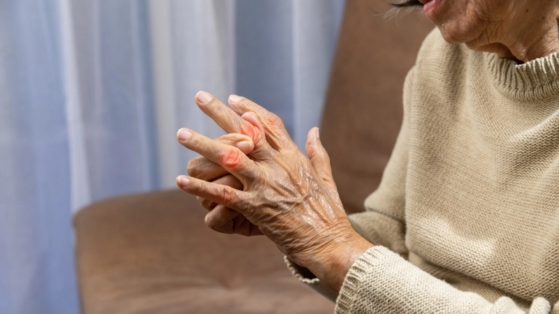 Hình ảnh gút với các tinh thể urat lắng đọng