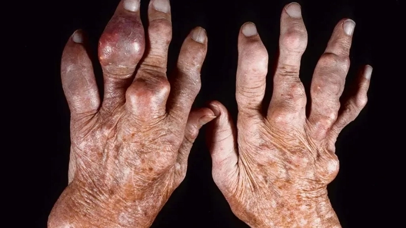 Hình ảnh về bệnh gout và tác động lên khớp