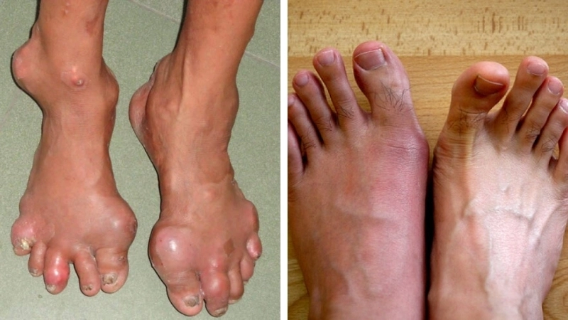 Top những hình ảnh về cơn gout cấp tính và hạt tophi