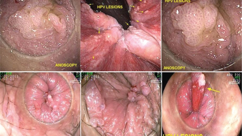 Hình ảnh vi khuẩn Haemophilus ducreyi là nguyên nhân gây bệnh