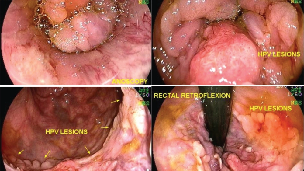 Vết loét hạ cam mềm, bờ không đều và có mủ