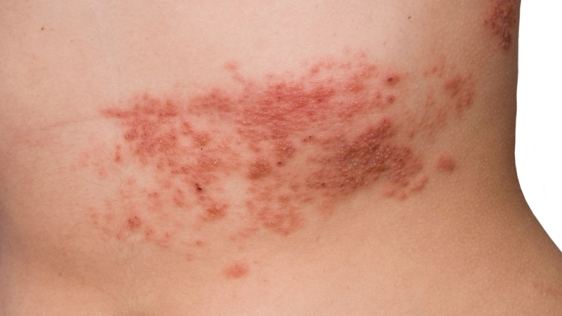 Thuốc bôi Acyclovir được chỉ định cho các trường hợp Herpes nhẹ