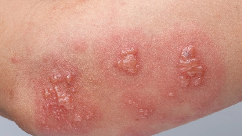 Cấu trúc của virus HSV dưới kính hiển vi điện tử