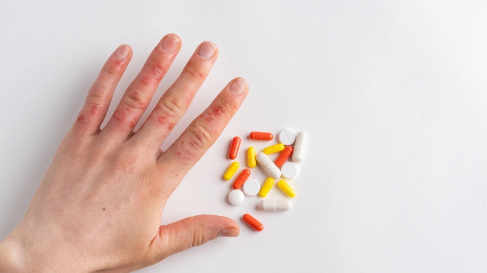 Hình ảnh bệnh hồng ban đa dạng ở tay và chân