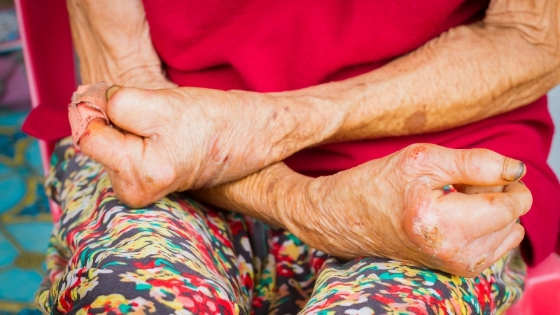 Cuộc sống của bệnh nhân tại các trại phong trước đây