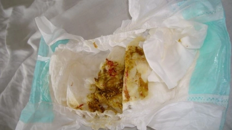 Cháo loãng là gợi ý cho câu hỏi bệnh kiết lỵ ăn gì để dễ tiêu hóa