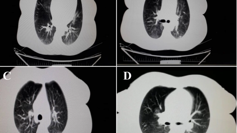 Các loại thuốc trị kiết lỵ phổ biến trong đơn của bác sĩ