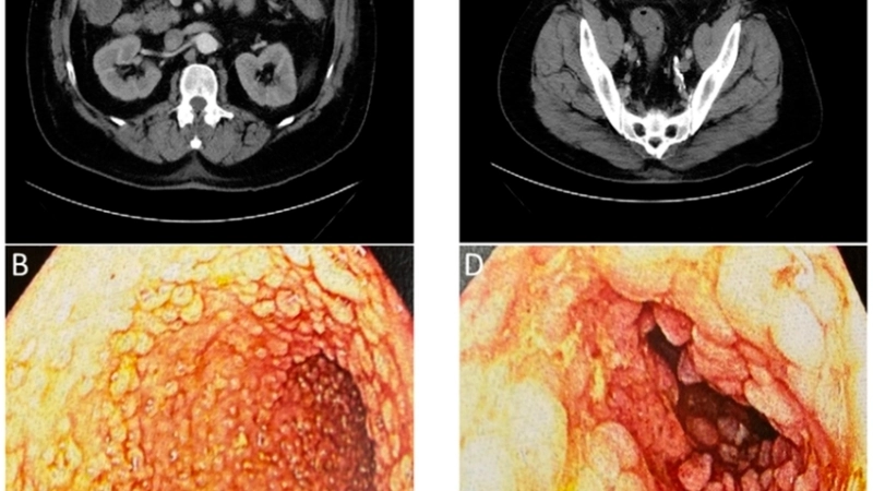 Mẫu phân có lẫn máu và chất nhầy là triệu chứng bệnh kiết lỵ nặng
