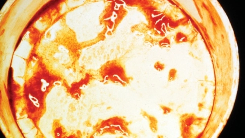 Hình ảnh bệnh kiết lỵ và những triệu chứng đi kèm nguy hiểm