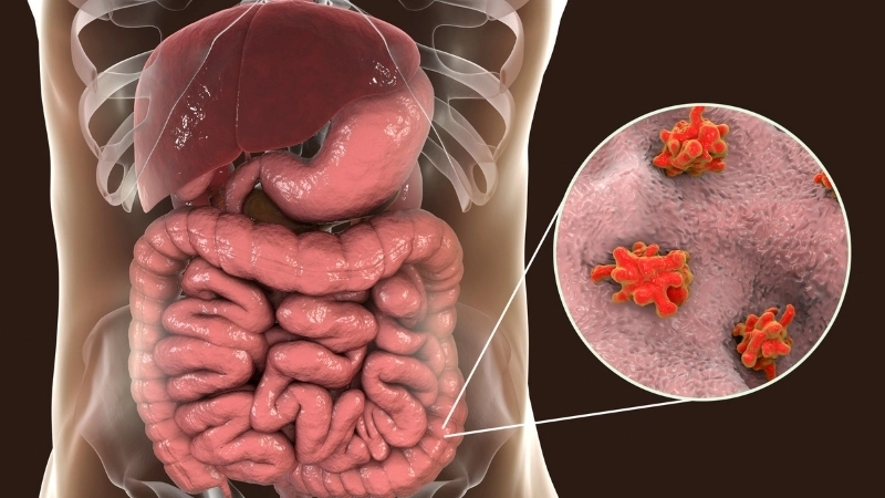 Biểu hiện đau quặn bụng là triệu chứng bệnh kiết lỵ điển hình