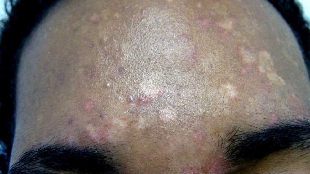 Các phương pháp trong cách trị lang ben đỏ hiệu quả