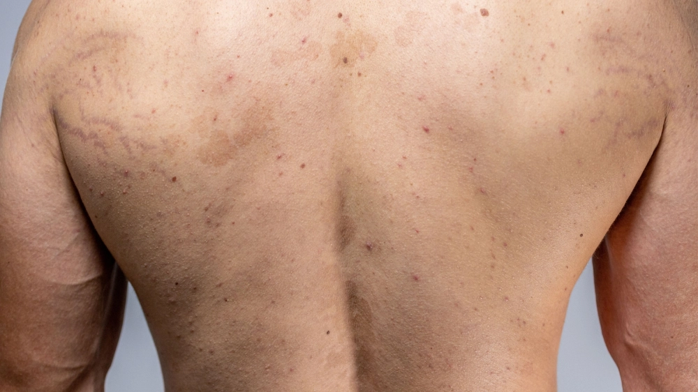  Lang ben đỏ là gì và biểu hiện trên da với các dát hồng ban có vảy mịn