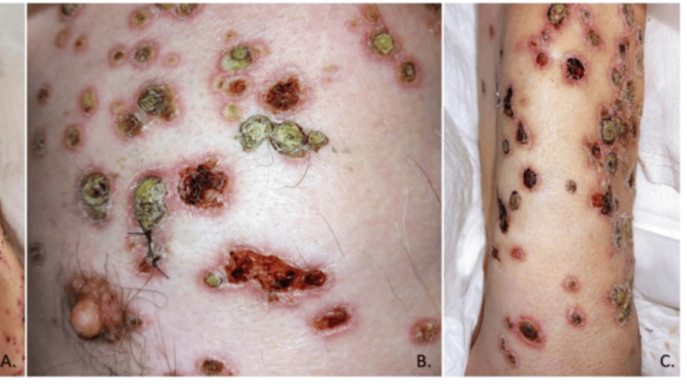 Hình ảnh các thể lao da thường gặp trong y văn