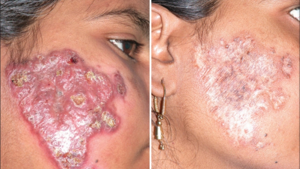 Quy trình thực hiện xét nghiệm lao da tại bệnh viện