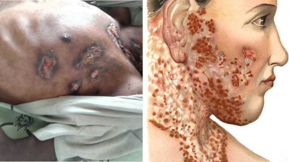 Dấu hiệu bệnh lao da với các vết loét lâu ngày không lành