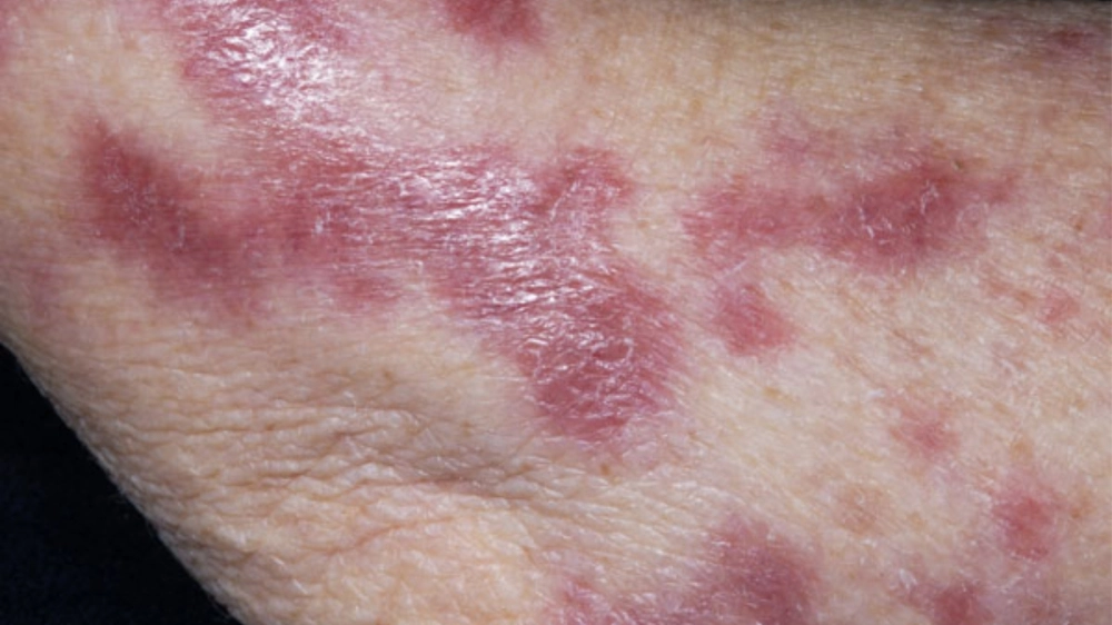 Cách điều trị bệnh lao da bằng thuốc kháng lao theo chỉ định