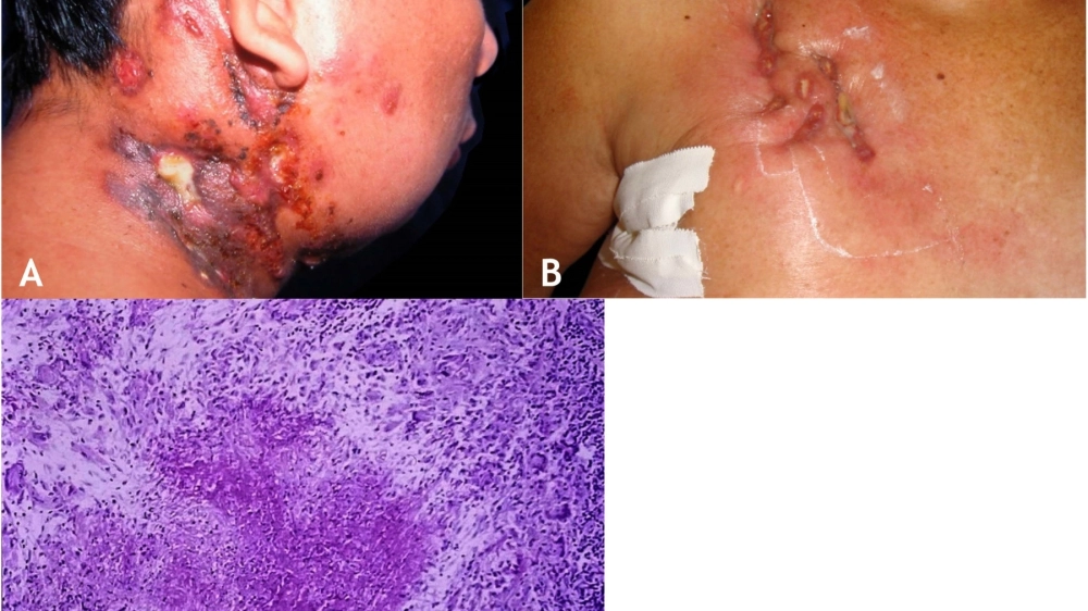 Kỹ thuật xét nghiệm lao da giúp xác định sự hiện diện của vi khuẩn lao trong tổn thương.