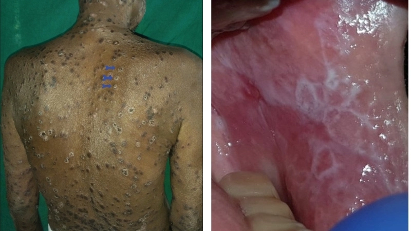 Triệu chứng bệnh lichen trên da và niêm mạc rõ nét