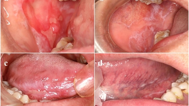 Phác đồ cách điều trị bệnh lichen được bác sĩ chỉ định