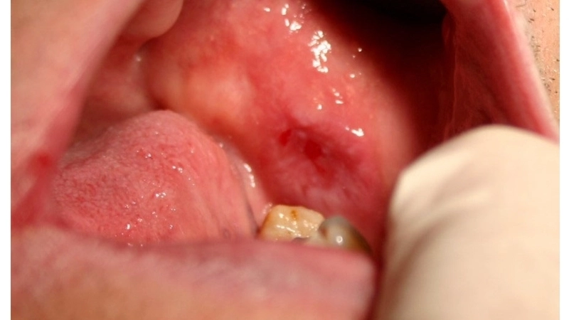 Giải đáp thắc mắc bệnh lichen có lây không trong cộng đồng